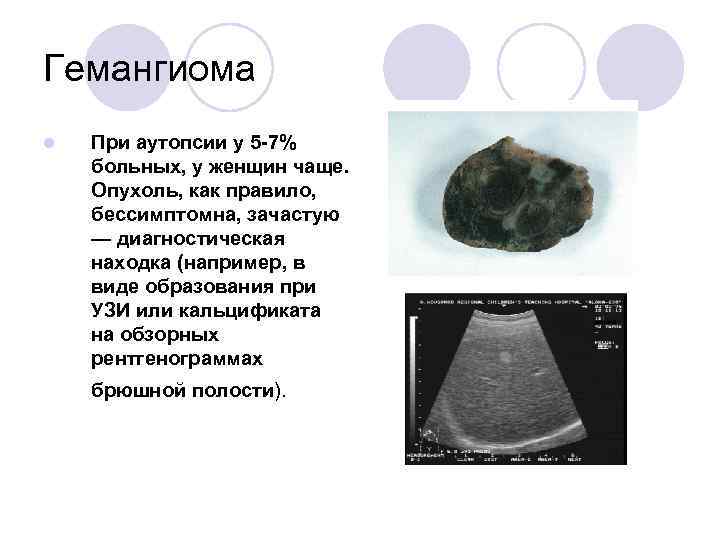 Гемангиома l При аутопсии у 5 -7% больных, у женщин чаще. Опухоль, как правило,