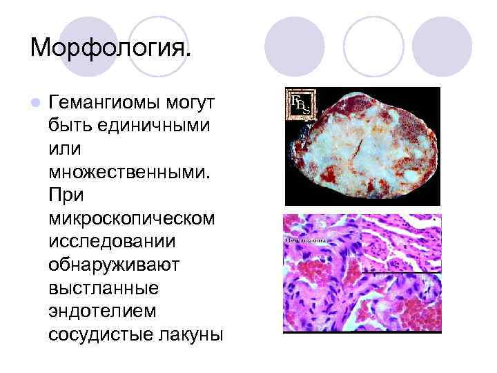 Опухоли печени презентация