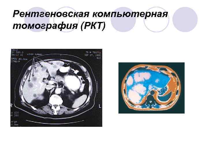 Рентгеновская компьютерная томография (РКТ) 