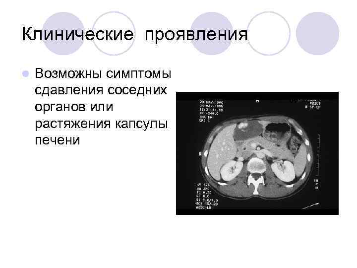 Клинические проявления l Возможны симптомы сдавления соседних органов или растяжения капсулы печени 