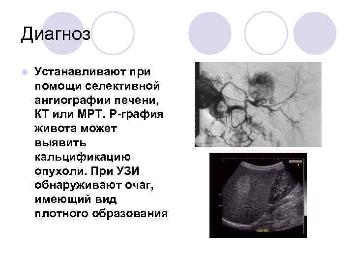 Диагноз l Устанавливают при помощи селективной ангиографии печени, КТ или МРТ. Р-графия живота может