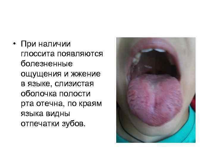  • При наличии глоссита появляются болезненные ощущения и жжение в языке, слизистая оболочка