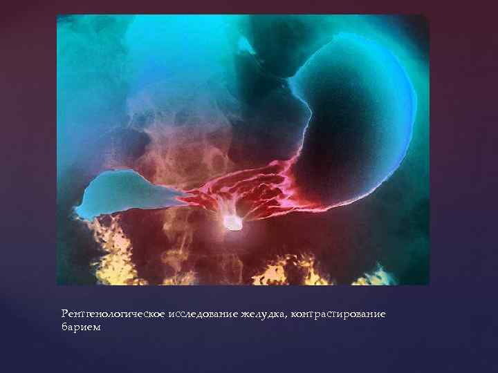Рентгенологическое исследование желудка, контрастирование барием 