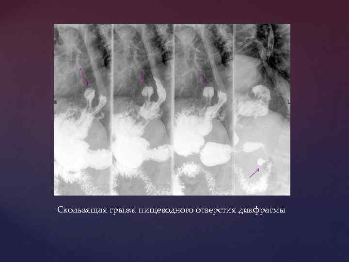 Скользящая грыжа пищеводного отверстия диафрагмы 