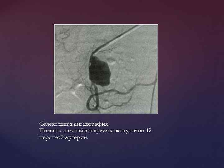 Селективная ангиография. Полость ложной аневризмы желудочно-12 перстной артерии. 