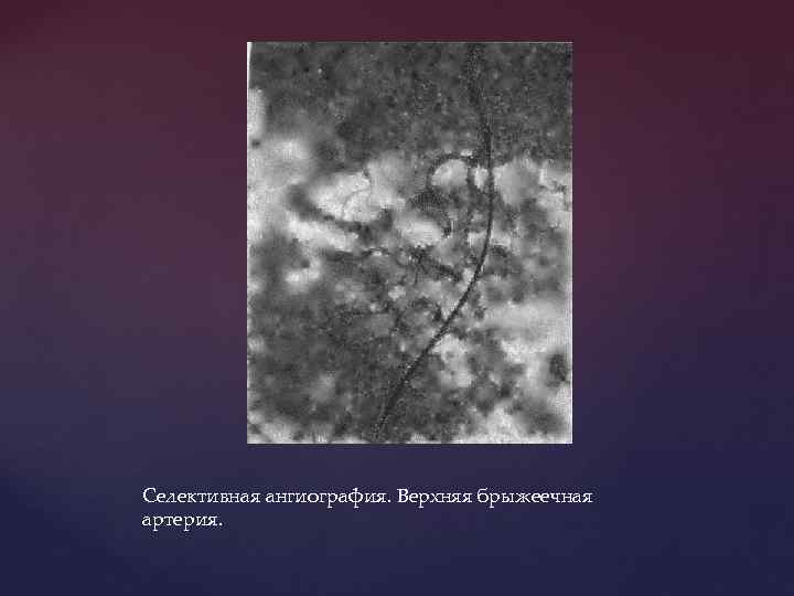 Селективная ангиография. Верхняя брыжеечная артерия. 