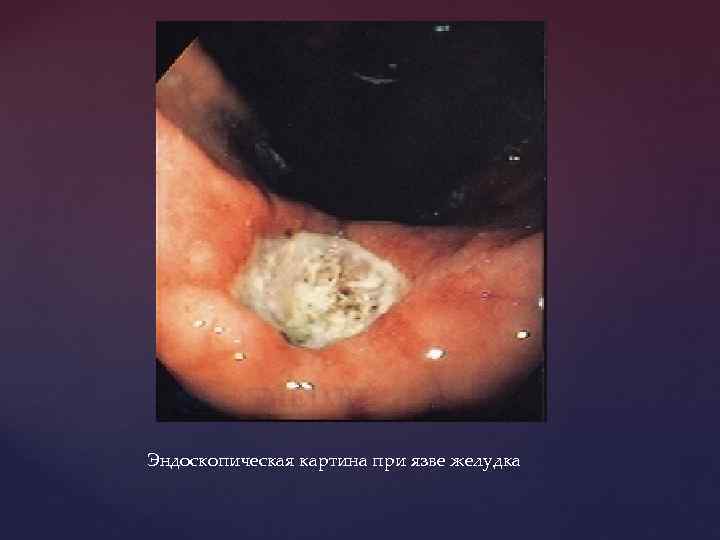 Эндоскопическая картина при язве желудка 