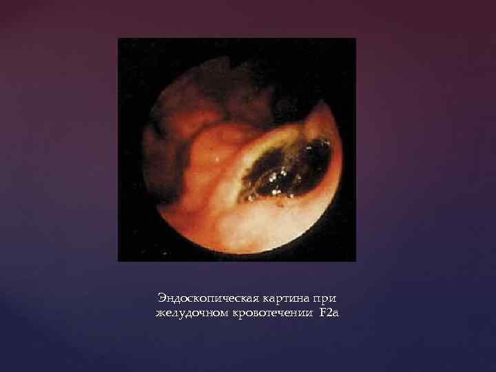 Эндоскопическая картина при желудочном кровотечении F 2 a 