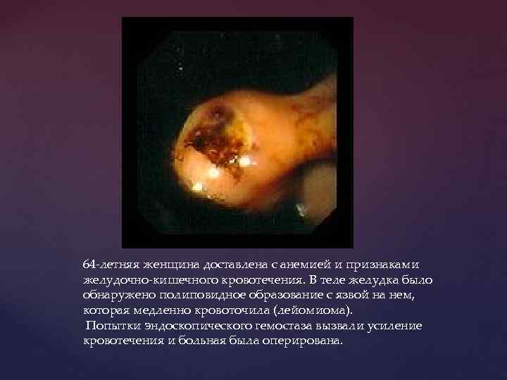64 -летняя женщина доставлена с анемией и признаками желудочно-кишечного кровотечения. В теле желудка было