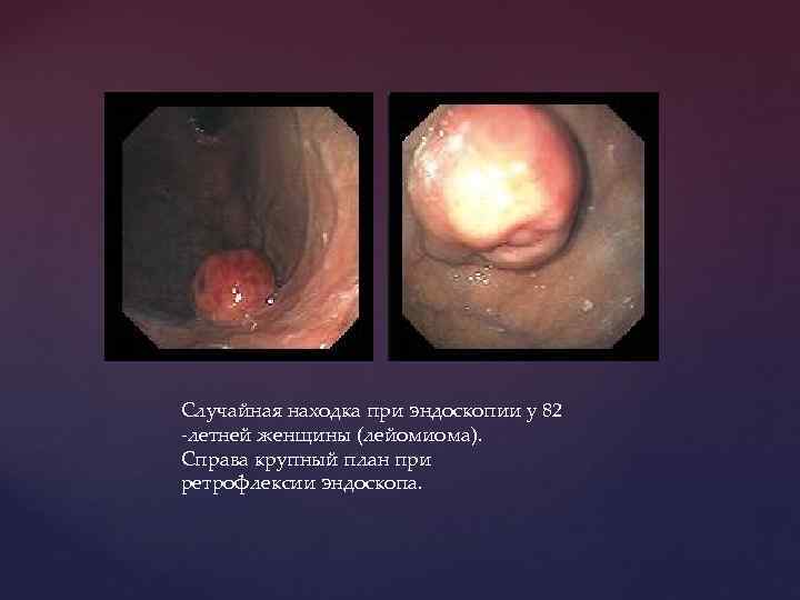 Случайная находка при эндоскопии у 82 -летней женщины (лейомиома). Справа крупный план при ретрофлексии