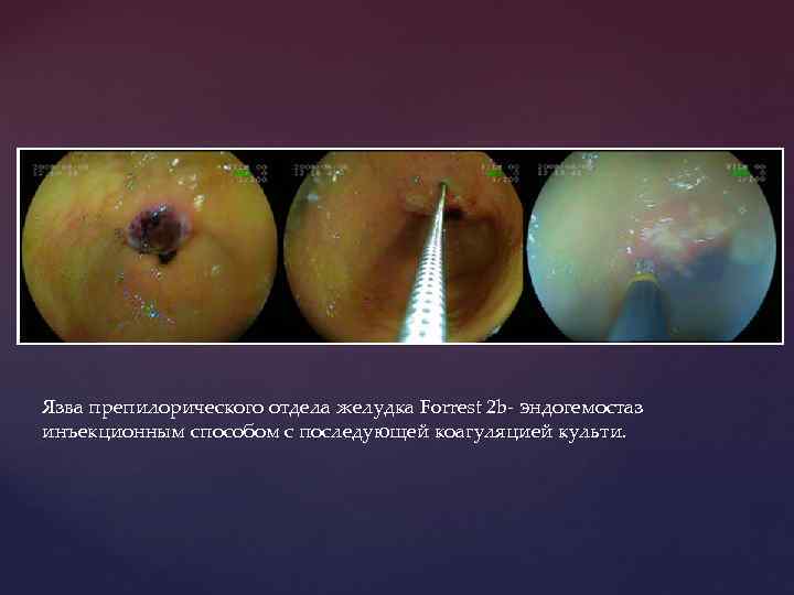 Язва препилорического отдела желудка Forrest 2 b- эндогемостаз инъекционным способом с последующей коагуляцией культи.