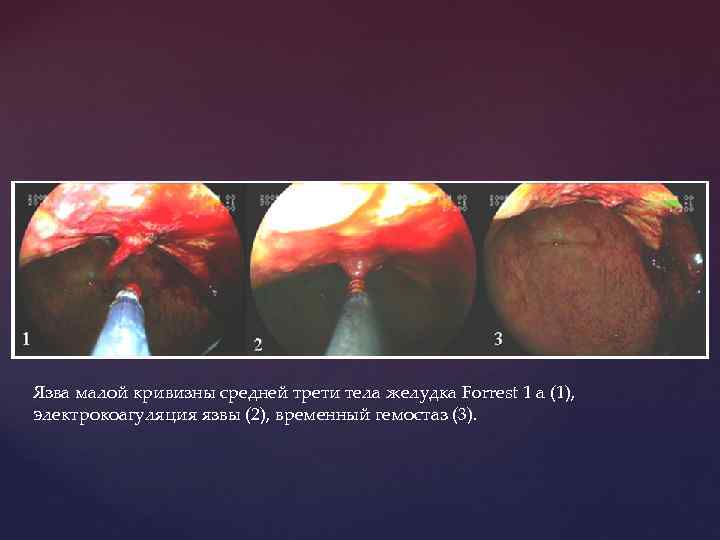 Язва малой кривизны средней трети тела желудка Forrest 1 a (1), электрокоагуляция язвы (2),