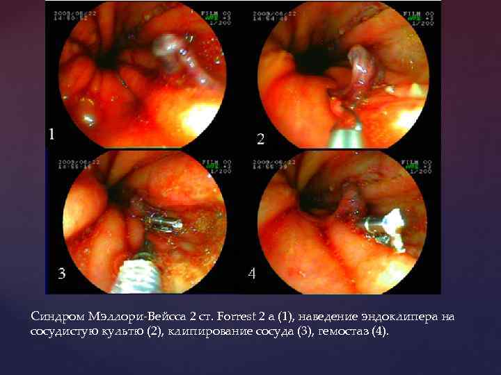 Синдром Мэллори-Вейсса 2 ст. Forrest 2 a (1), наведение эндоклипера на сосудистую культю (2),