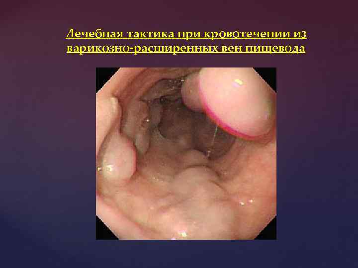 Лечебная тактика при кровотечении из варикозно-расширенных вен пищевода 