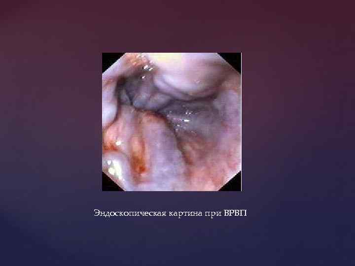 Эндоскопическая картина при ВРВП 