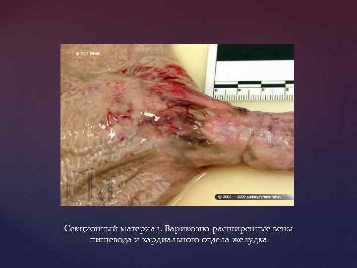 Секционный материал. Варикозно-расширенные вены пищевода и кардиального отдела желудка 