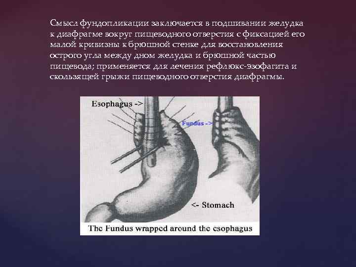 Смысл фундопликации заключается в подшивании желудка к диафрагме вокруг пищеводного отверстия с фиксацией его