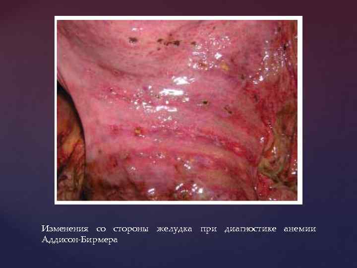 Изменения со стороны желудка при диагностике анемии Аддисон-Бирмера 