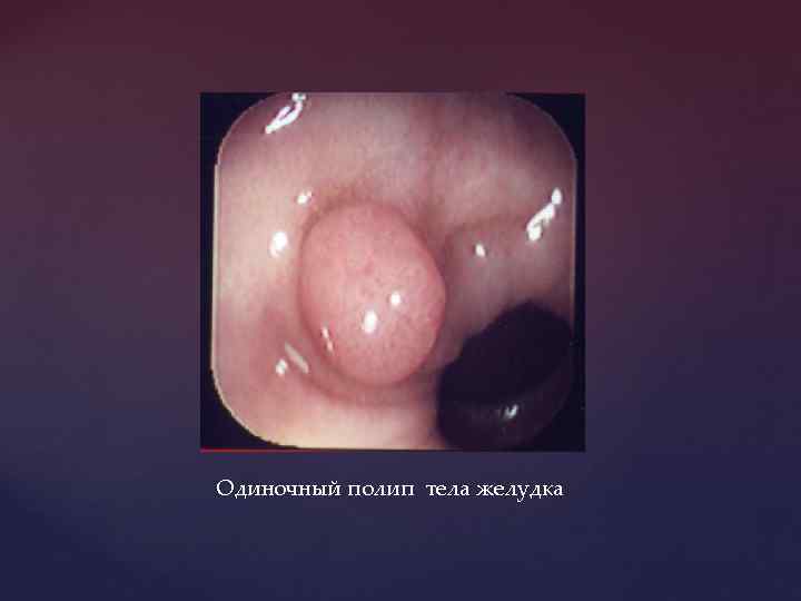 Одиночный полип тела желудка 