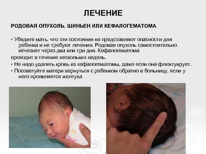 ЛЕЧЕНИЕ РОДОВАЯ ОПУХОЛЬ, ШИНЬЕН ИЛИ КЕФАЛОГЕМАТОМА • Убедите мать, что эти состояния не представляют