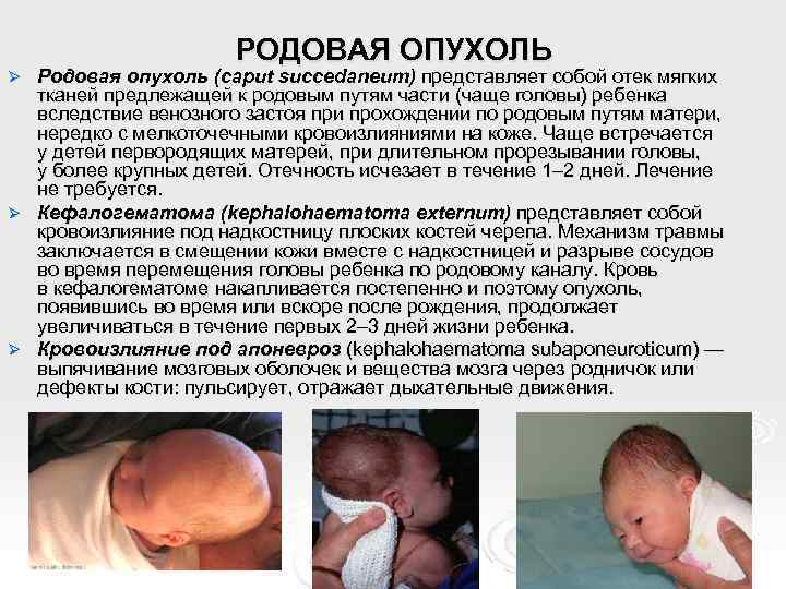 РОДОВАЯ ОПУХОЛЬ Родовая опухоль (caput succedaneum) представляет собой отек мягких тканей предлежащей к родовым