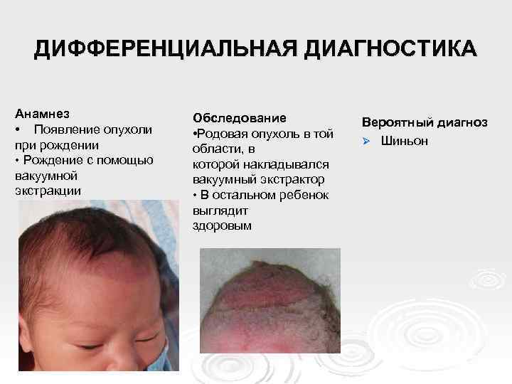 ДИФФЕРЕНЦИАЛЬНАЯ ДИАГНОСТИКА Анамнез • Появление опухоли при рождении • Рождение с помощью вакуумной экстракции