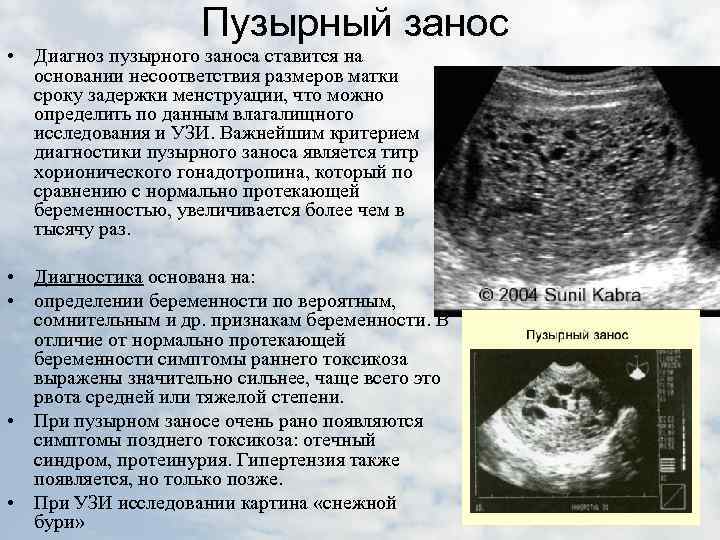 Неразвивающаяся беременность код. Пузырный занос УЗИ картина. Клинические признаки пузырного заноса. Пузырный занос УЗИ признаки.