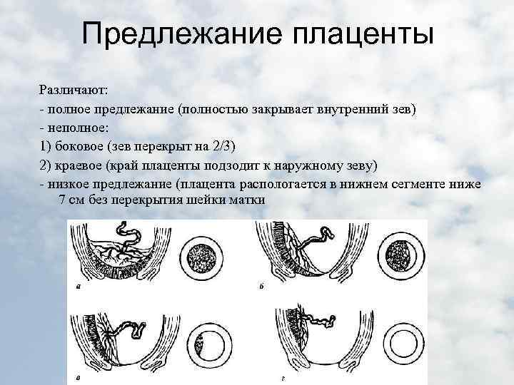 Кровотечение во время беременности презентация