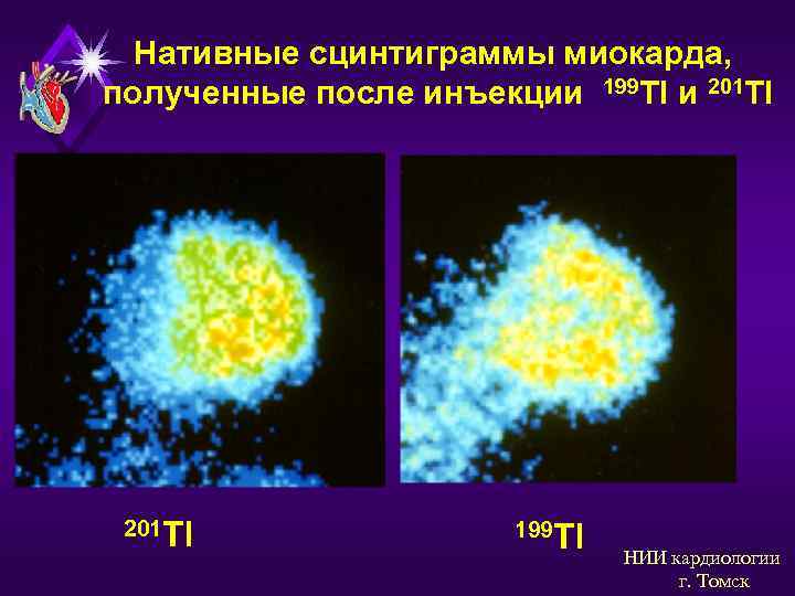 Нативные сцинтиграммы миокарда, полученные после инъекции 199 Тl и 201 Tl 201 Тl 199