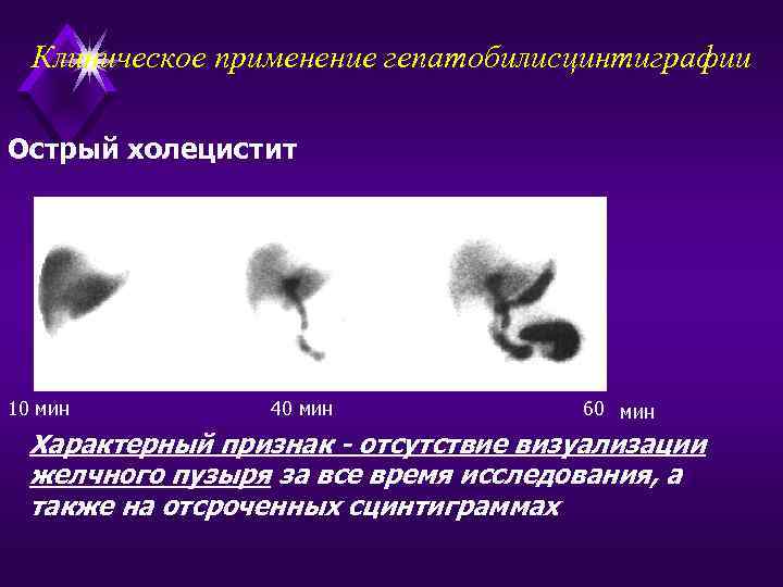 Клиническое применение гепатобилисцинтиграфии Острый холецистит 10 мин 40 мин 60 мин Характерный признак -