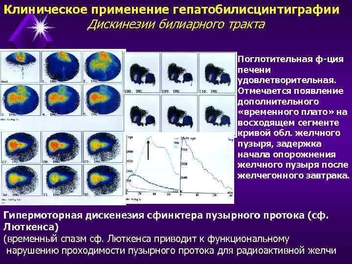 Клиническое применение гепатобилисцинтиграфии Дискинезии билиарного тракта Поглотительная ф-ция печени удовлетворительная. Отмечается появление дополнительного «временного