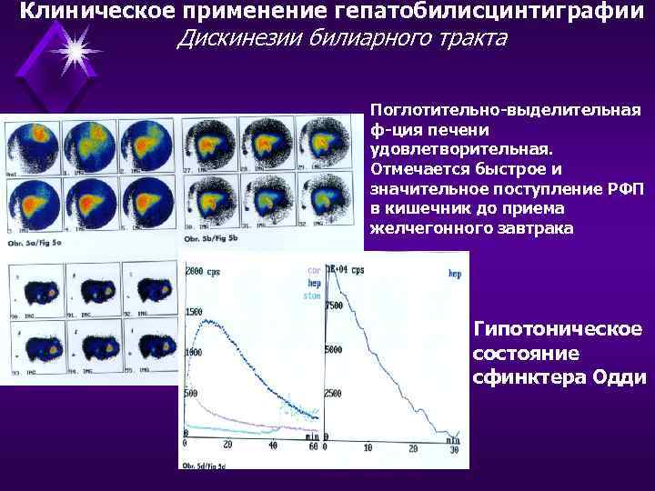 Клиническое применение гепатобилисцинтиграфии Дискинезии билиарного тракта Поглотительно-выделительная ф-ция печени удовлетворительная. Отмечается быстрое и значительное