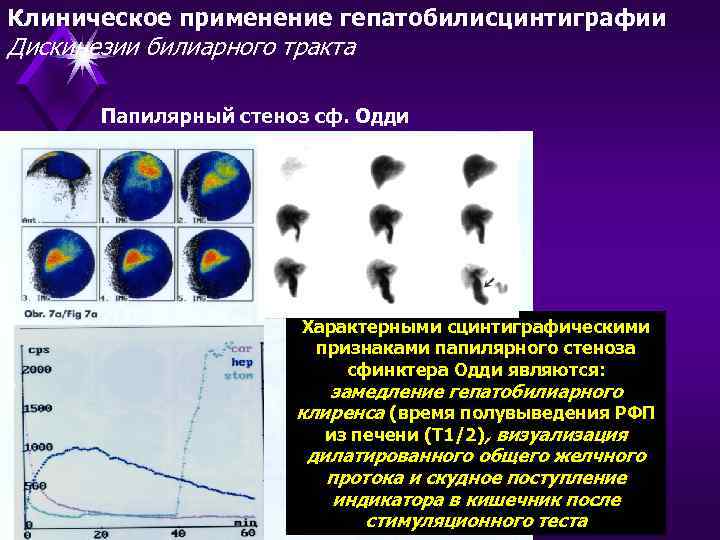 Клиническое применение гепатобилисцинтиграфии Дискинезии билиарного тракта Папилярный стеноз сф. Одди А Характерными сцинтиграфическими признаками