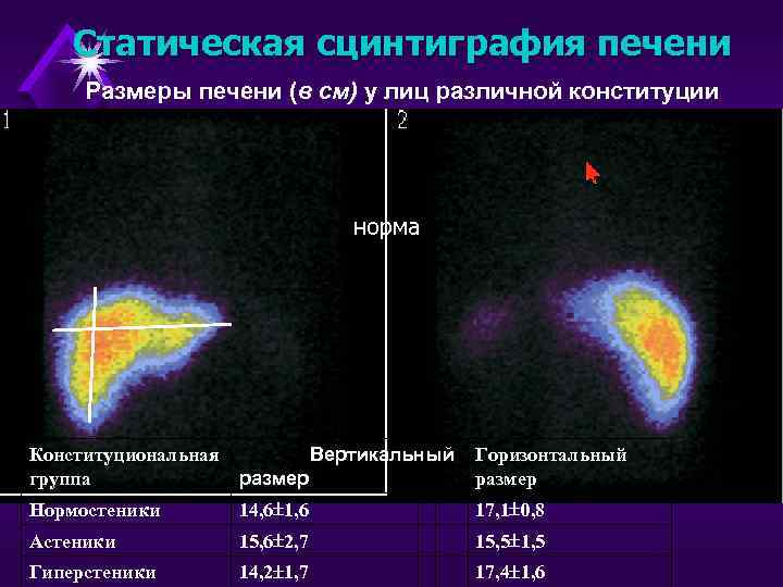 Статическая сцинтиграфия печени Размеры печени (в см) у лиц различной конституции норма Конституциональная Вертикальный