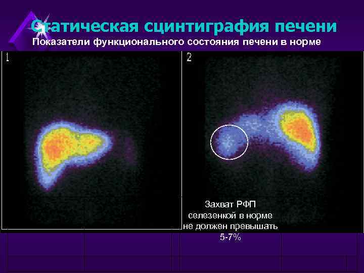 Статическая сцинтиграфия печени Показатели функционального состояния печени в норме Захват РФП селезенкой в норме