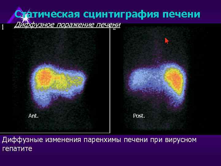 Статическая сцинтиграфия печени Диффузное поражение печени Ant. Post. Диффузные изменения паренхимы печени при вирусном