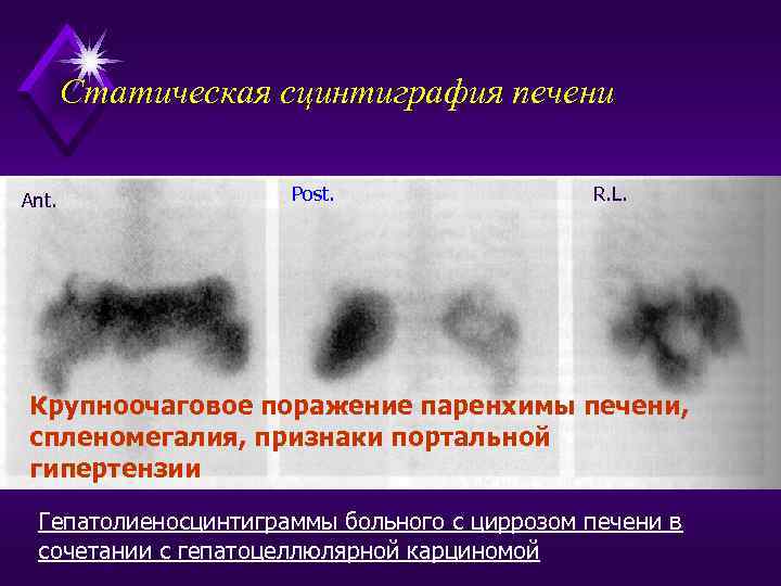 Статическая сцинтиграфия печени Ant. Post. R. L. Крупноочаговое поражение паренхимы печени, спленомегалия, признаки портальной