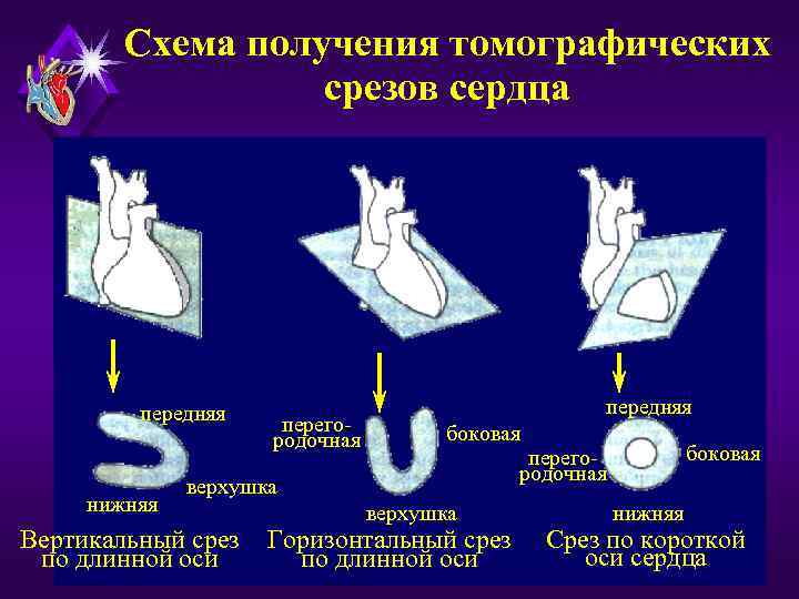 Схема получения томографических срезов сердца передняя нижняя перегородочная передняя боковая верхушка Вертикальный срез по