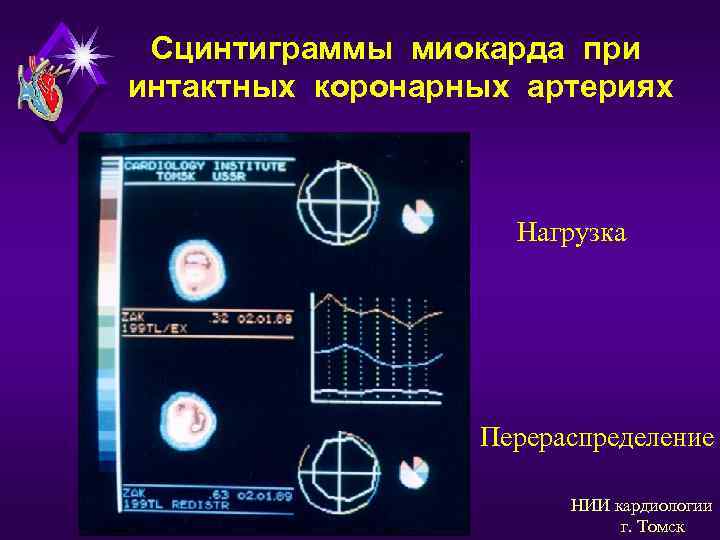 Сцинтиграммы миокарда при интактных коронарных артериях Нагрузка Перераспределение НИИ кардиологии г. Томск 