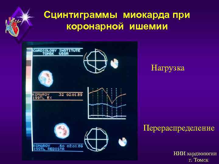 Сцинтиграммы миокарда при коронарной ишемии Нагрузка Перераспределение НИИ кардиологии г. Томск 