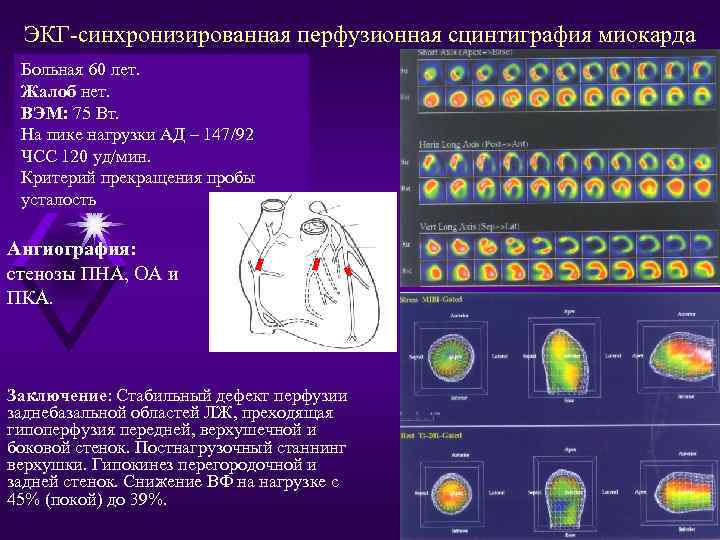 Может ли сцинтиграфия не увидеть мтс