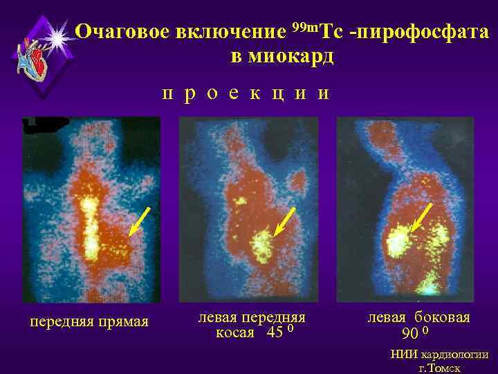 Очаговое включение 99 m. Tc -пирофосфата в миокард п р о е к ц