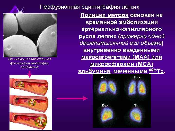 Перфузионная сцинтиграфия легких Принцип метода основан на временной эмболизации артериально-капиллярного русла легких (примерно одной