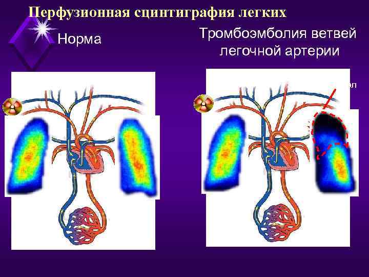 Клапан легочной артерии норма