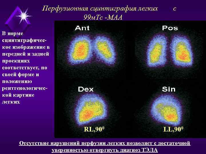 Перфузионная сцинтиграфия легких 99 м. Тс -МАА с В норме сцинтиграфическое изображение в передней