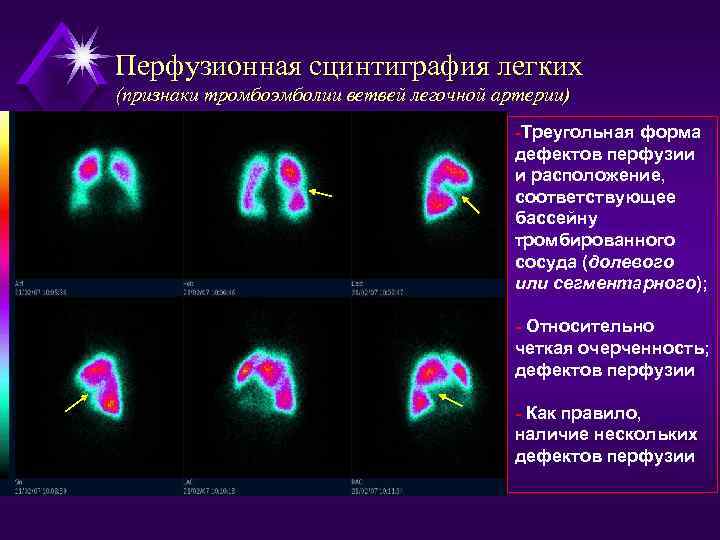 Перфузионная сцинтиграфия легких (признаки тромбоэмболии ветвей легочной артерии) -Треугольная форма дефектов перфузии и расположение,