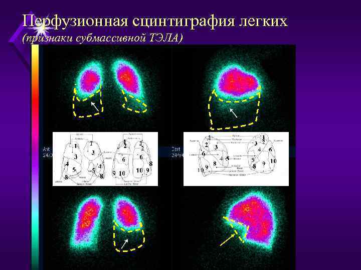 Перфузионная сцинтиграфия легких (признаки субмассивной ТЭЛА) 