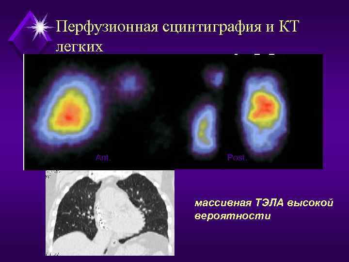 Перфузионная сцинтиграфия и КТ легких Ant. Post. массивная ТЭЛА высокой вероятности 