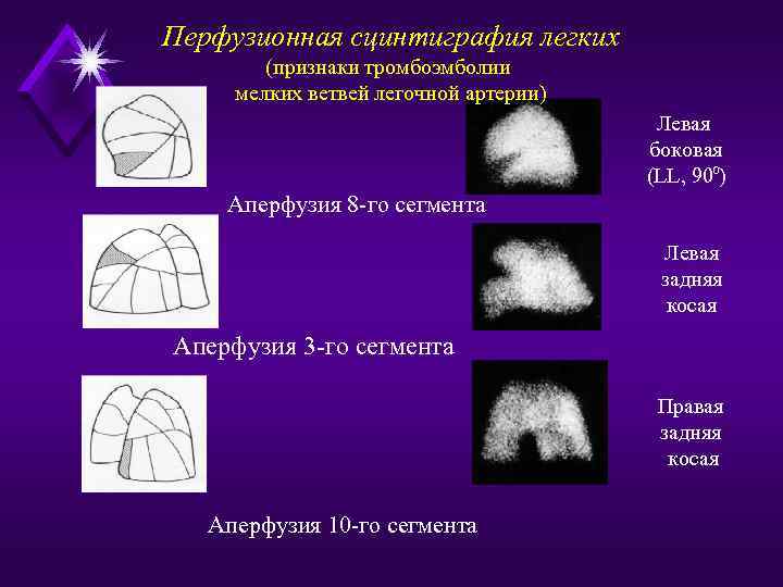 Перфузионная сцинтиграфия легких (признаки тромбоэмболии мелких ветвей легочной артерии) Левая боковая (LL, 900) Аперфузия