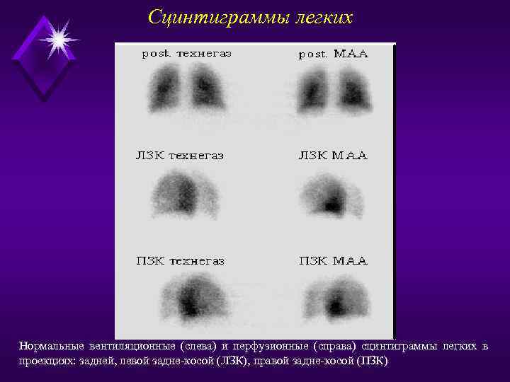 Сцинтиграммы легких Нормальные вентиляционные (слева) и перфузионные (справа) сцинтиграммы легких в проекциях: задней, левой